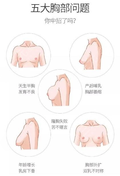 广州隆胸手术哪家医院好？广州隆胸手术案例反馈