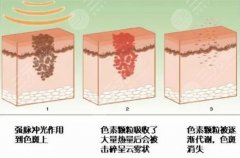 超激光美肤激光嫩肤多少钱？2022参考价格分享，扫黄美白心选择！