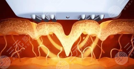 超激光美肤激光美白