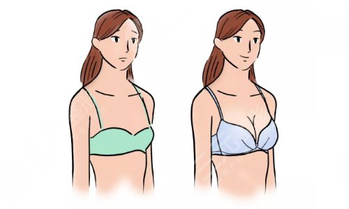 棉花糖隆胸真的不疼吗?可信吗?棉花糖隆胸案例术后:s曲线爆美!