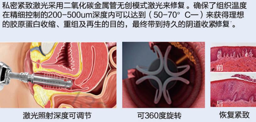 什么是妇科激光私密激光有副作用吗？科普分析，带你掌握“性福密码”！_https://www.jmylbn.com_新闻资讯_第3张