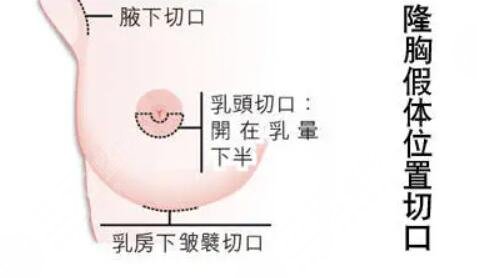 做假体隆胸术后反馈