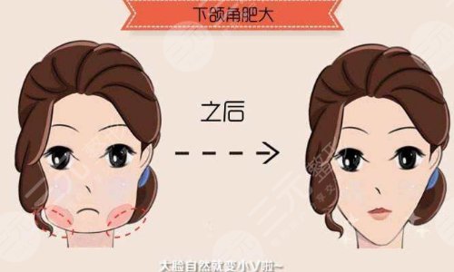 磨骨手术后成好吗?