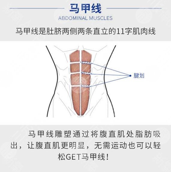 马甲线吸脂怎么做，有果吗？科普&术后事项分享，塑形正当时！