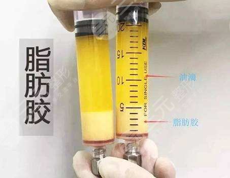 脂肪胶和脂肪填充哪个更好?科普讲解区别在哪,医美不上当! 脂肪胶和脂肪填充哪个更好?科普讲解区别在哪,医美不上当!