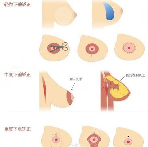 棉花糖隆胸真的不疼吗?
