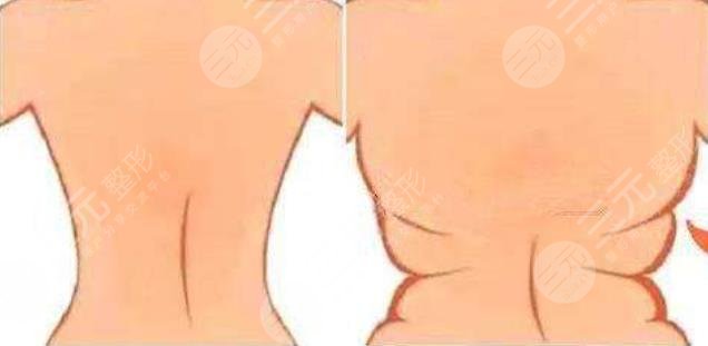 马甲线吸脂
