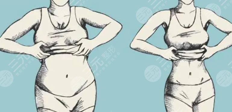 马甲线吸脂多少钱？价格+注意事项分享，2022美体塑形必看！