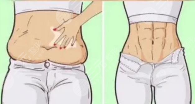 马甲线吸脂