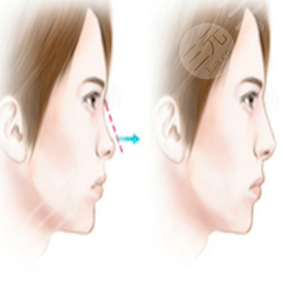 贵阳美贝尔整形口碑如何？诚意分享B****术后对比