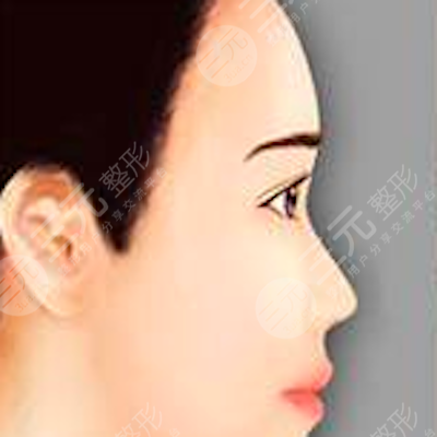 南京华美整形注射美容果好不好？B****术后果分享
