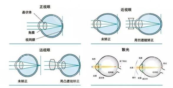 广东省人民医院飞秒激光近视手术介绍