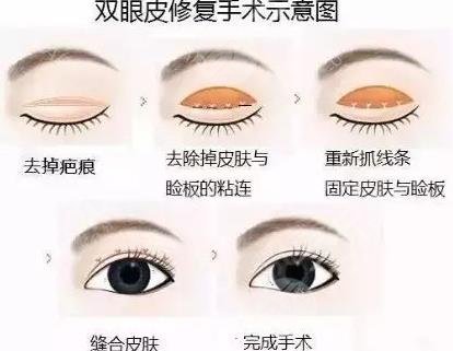 白永辉医生擅长项目科普:眼修复(修复双眼皮)