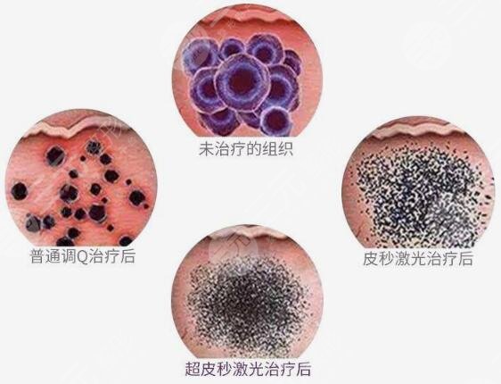 超激光美肤激光 果