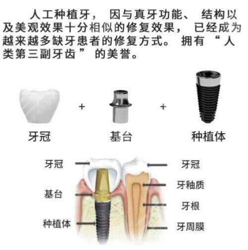 中山大学附属第一医院种植牙技术