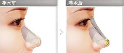 济南艺星做鼻部手术案例