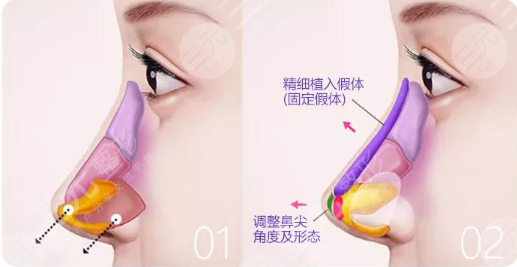 硅胶隆鼻有哪些好处?