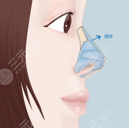 硅胶隆鼻后的注意事项有哪些?
