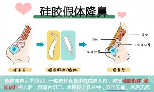 硅胶隆鼻后会出现鼻尖假体外露的情况吗?