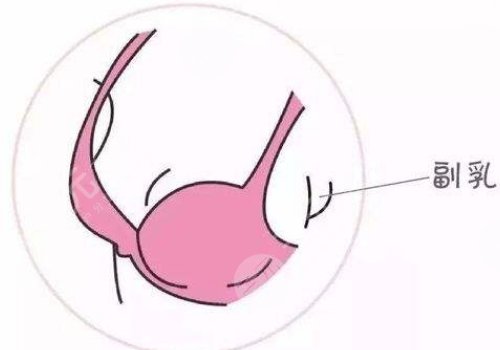 副乳手术有哪些注意事项?