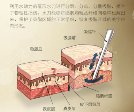 水动力吸脂和黄金微雕的恢复期