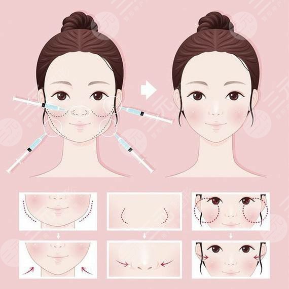 北京金晟丽人医疗美容诊所脸部吸脂案例