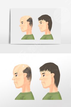 北京新生毛发科医院植发案例