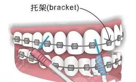 南京金属矫正牙齿项目案例体验反馈: