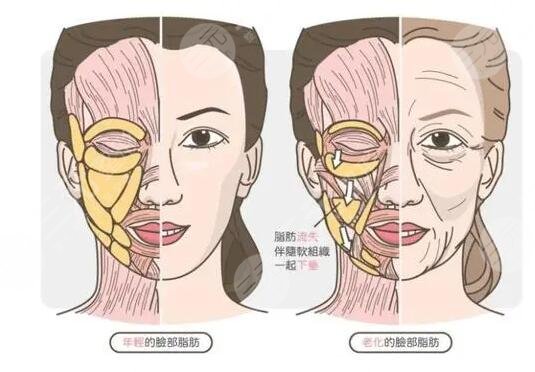 八大处大拉皮除皱术案例