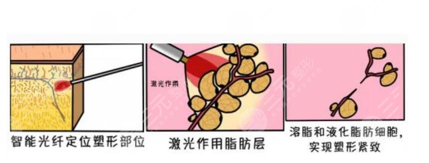 吸脂