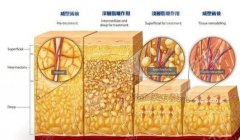 威塑抽脂价格多少，贵很多吗？2022美体塑形攻略分享！