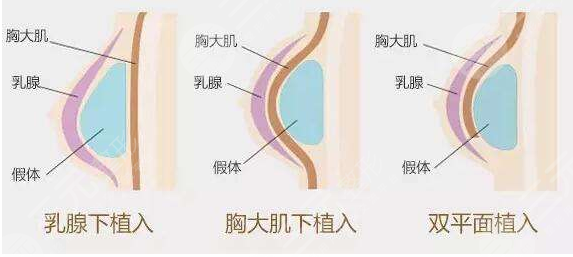 美国娜绮丽假体术前要做什么准备？