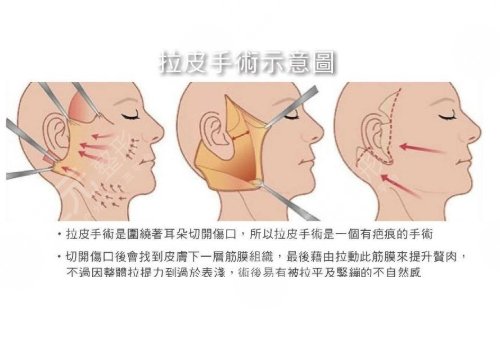 二十多岁可以做拉皮吗?拉皮手术原理适宜人群有哪些?果真的那么神奇?