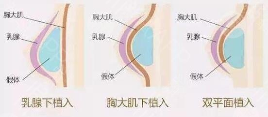 德国宝俪假体价格是多少钱?