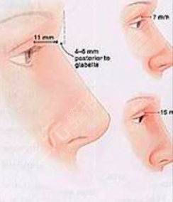 膨体隆鼻果怎么样  膨体隆鼻术后果分享