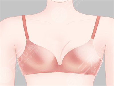 北京自体脂肪移植专家冯斌自体隆胸+全脸脂肪填充价格案例