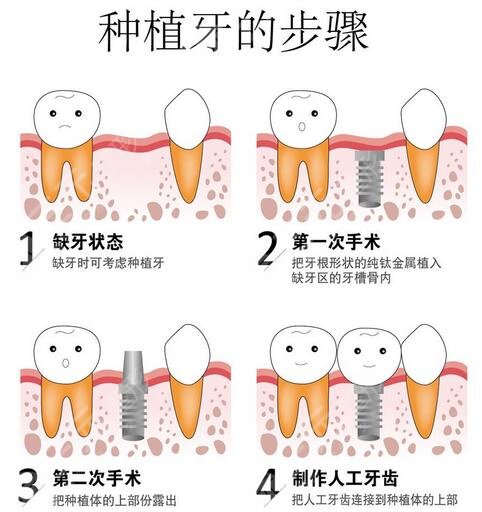 广州南方医院种植牙技术