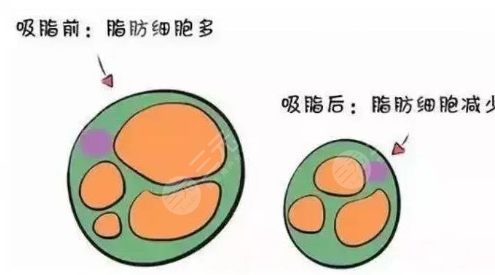 威塑抽脂