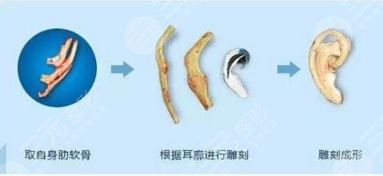 耳再造