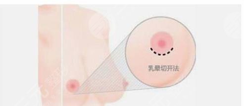 隆胸