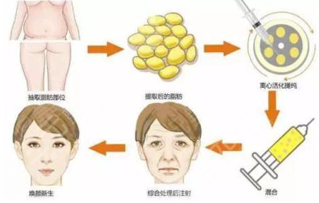 八大处王永前脂肪填充好吗？