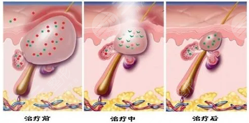 痘坑凹洞能不能修复？多少钱？价格一览+4个有的方法盘点！