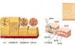 超脂塑体雕术与传统抽脂的区别科普：贵得有道理？优点对比！