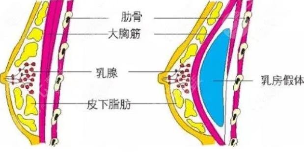 隆胸