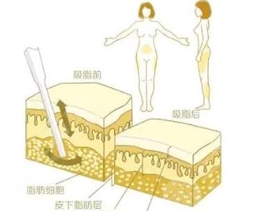 吸脂