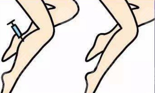 如何瘦小腿？