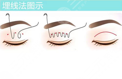 双眼皮埋线是如何操作的?