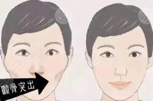 颧骨突出怎么改良?