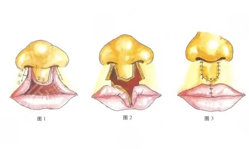 唇腭裂手术