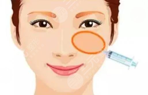 面部填充